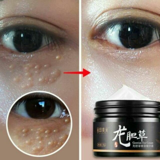 eye cream untuk milia