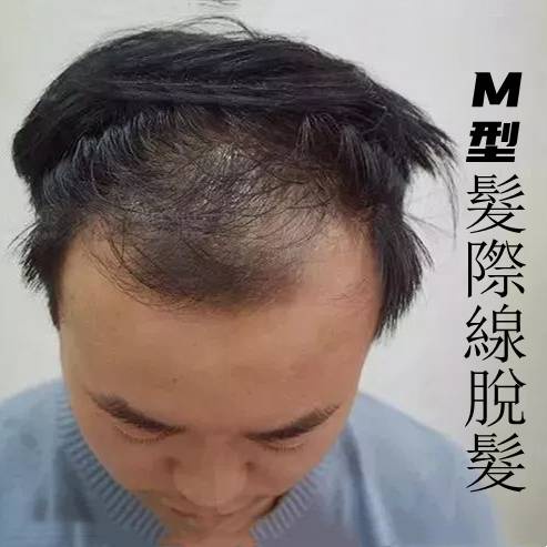 瀏海貼片 Ptt Dcard討論與高評價網拍商品 21年9月 飛比價格