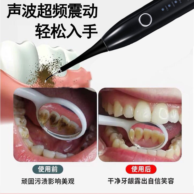 YS-牙結石去除器去牙結石牙垢超聲波潔牙器牙齒清潔器潔牙洗牙神器