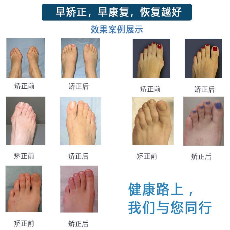 腳趾環 特價 錘狀趾矯正器成人兒童爪狀腳趾彎曲重疊指固定綁帶手指骨折矯正帶 蝦皮購物