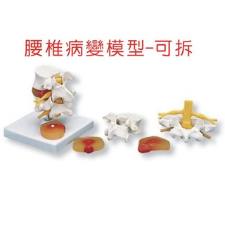 可開發票 (可拆)人體腰椎病變椎間盤模型 腰椎骨病變模型 骨骼模型 關節模型 腰椎病變模型 教學教具模型ARHD客滿來