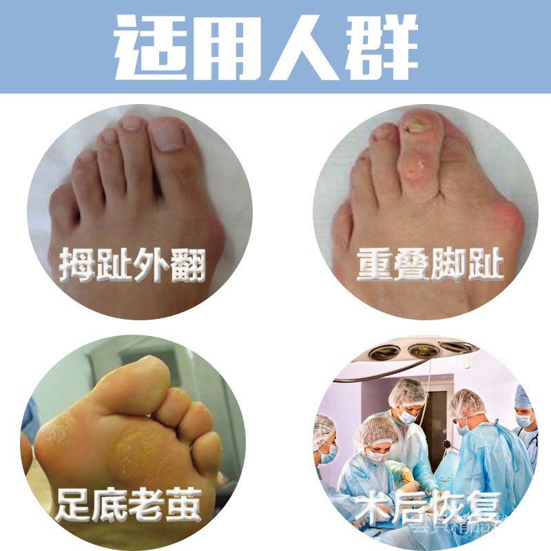 腳趾矯正器大拇指外翻夜用小腳趾內翻大腳骨分趾分離重疊趾前掌墊雲貝 蝦皮購物