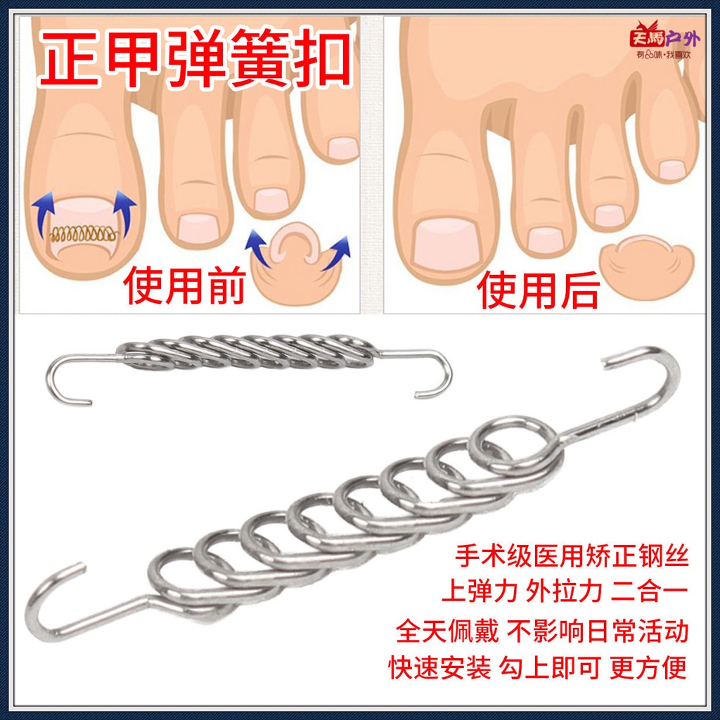 日本凍甲矯正器 Ptt Dcard討論與高評價網拍商品 2021年11月 飛比價格