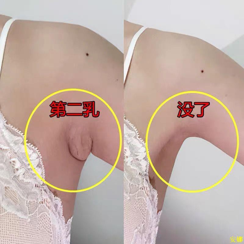 去副乳消除神器消副乳膏腋下贅肉腋窩副乳凸起先天性假乳多乳房癥 蝦皮購物