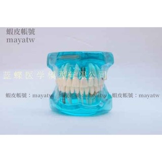 (MD-B_1477)牙科 齒科材料 修復模型 病理模型 活動牙可拆卸水晶模型 藍