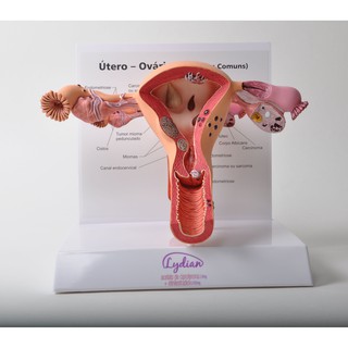 女性生殖系統 子宮病變 教學解剖模型 Diseased Uterus Model