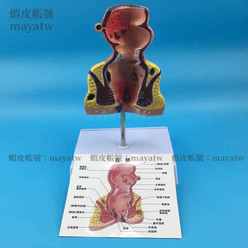 (MD-B_0581)直腸常見病理模型 人體直腸模型 腸道保健肛腸科大腸消化系統肛周
