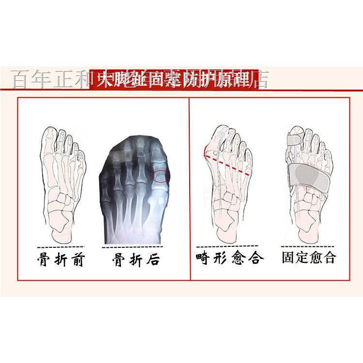 特惠工厂直销 大腳趾骨折護具夾板固定器大腳拇趾矯正骨裂跖骨趾骨骨折腳趾護具 蝦皮購物