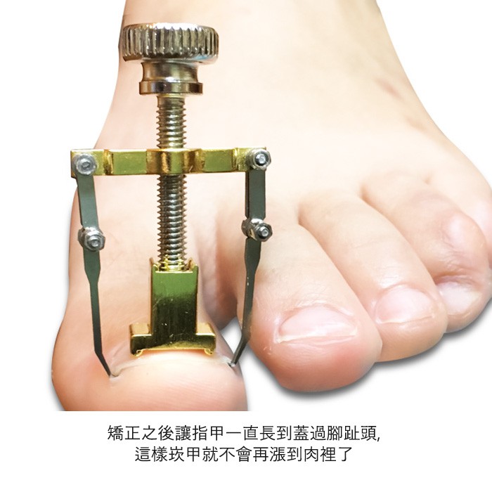3爪嵌甲矯正器指甲矯正器凍甲崁甲嵌甲卷甲腳趾甲矯正器甲溝炎nailsmall 蝦皮購物