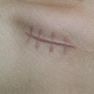 拆線傷口 優惠推薦 23年2月 蝦皮購物台灣