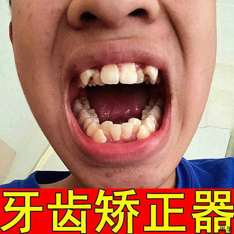 牙齒矯正器齙牙地包天矯正牙齒咬合不正門牙縫矯正防磨牙牙套成人 蝦皮購物