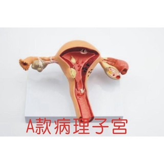 可開發票 A款 病理子宮模型 人體子宮模型 女性陰道模型 內外生殖器官 婦科醫學演示 子宮模型ARDL客滿來