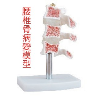 可開發票 人體腰椎病變骨質疏鬆模型 椎間盤腰椎組合模型骨骼模型 脊椎腰椎骨關節模型 教學教具模型ARDZ客滿來