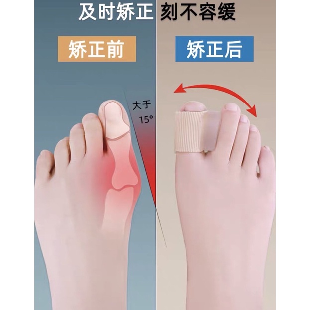 大母腳趾頭拇指外翻矯正器男女可以穿鞋大腳骨女士糾正分離分趾器