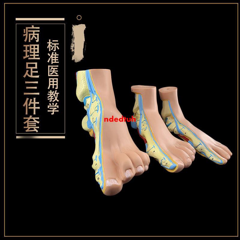 正常足弓形足高弓足模型腳關節模型爪形足腳部模型解剖醫院 蝦皮購物