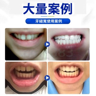 【台灣公司現貨-有發票】牙齒矯正器  9D隱形牙套 學生成人定制糾正器 夜間防磨牙牙套 牙齒調整器 牙不齊 齙牙糾正神器 #2