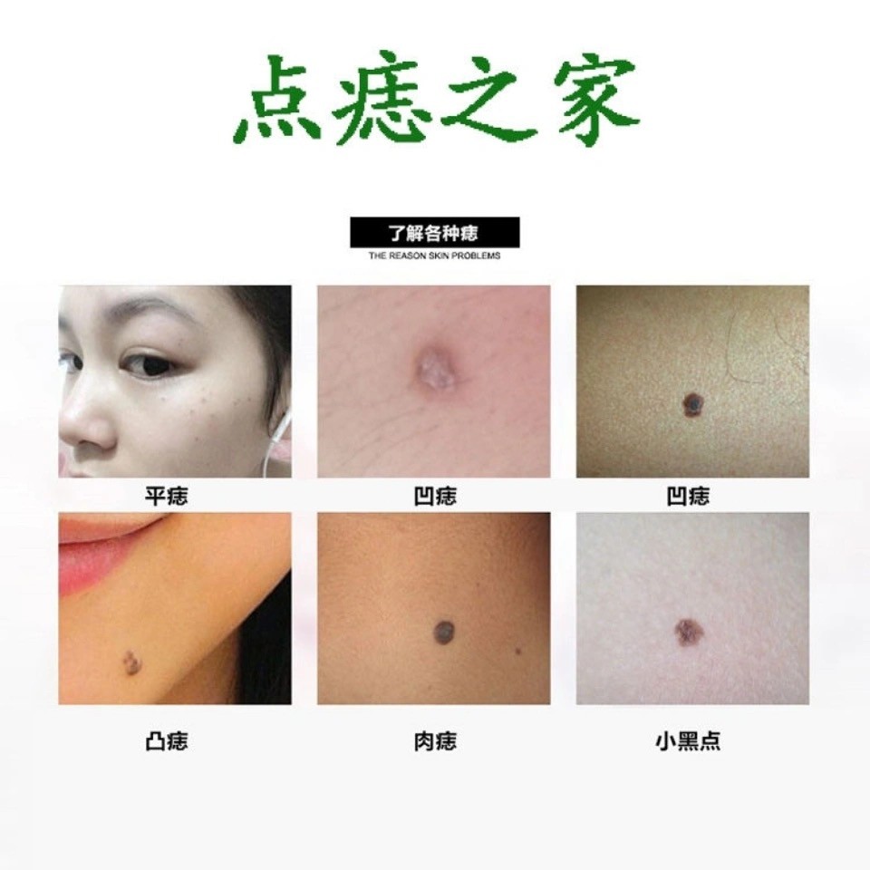 Be 点痣膏 祖傳秘方 去痣正品古法中藥溫和无痕祛痣除痣灵脸部痦子黑痣点斑水去雀斑肉痣