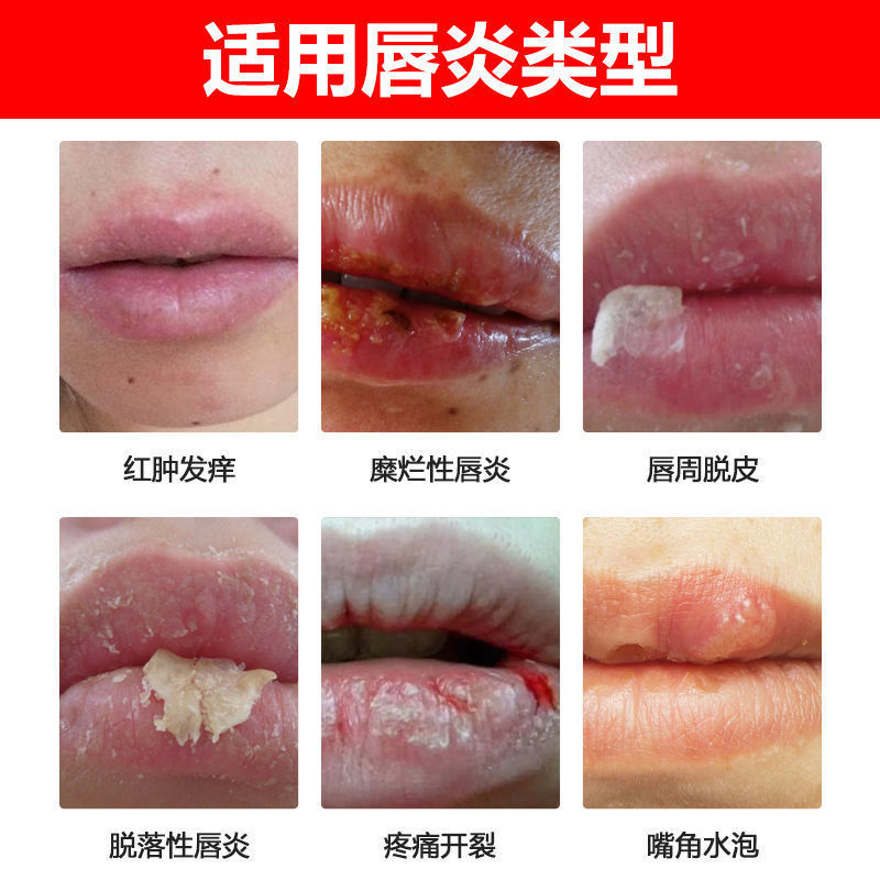 熱銷 特效唇炎膏 冶好不犯 潤唇膏修復嘴唇乾裂起皮唇周炎過敏性唇炎 蝦皮購物