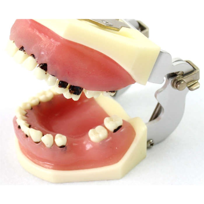 (ENOVO-109) 口腔重度牙周病學模型牙結石刮治牙齦縫合模型分瓣術