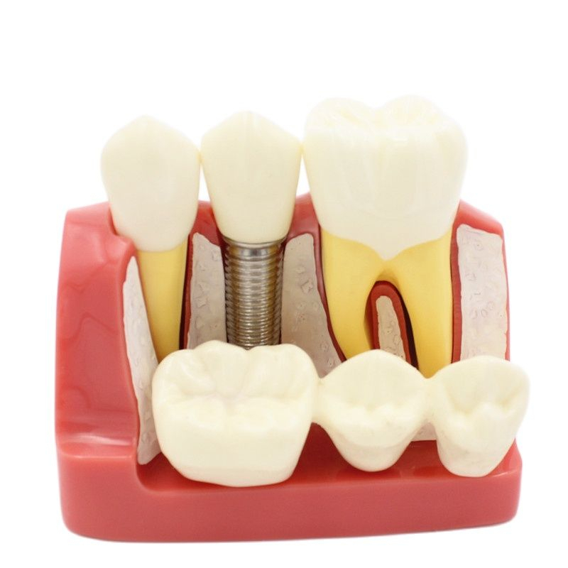 紅色四倍種植牙齒模型 口腔模型 訓練模型 部分可拆卸 醫患溝通口腔 教學練習修復解剖擺件 演示牙科牙齒模型