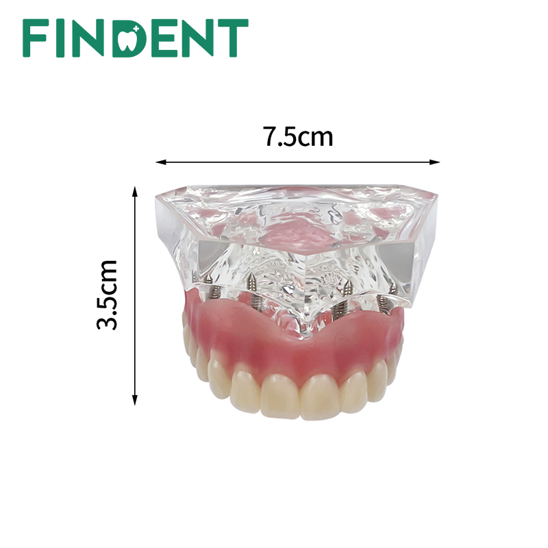 牙科牙齒模型,過度假牙模型,種植過度假牙模型透明上模型,四種植牙牙科模型過度教學和學習 6001