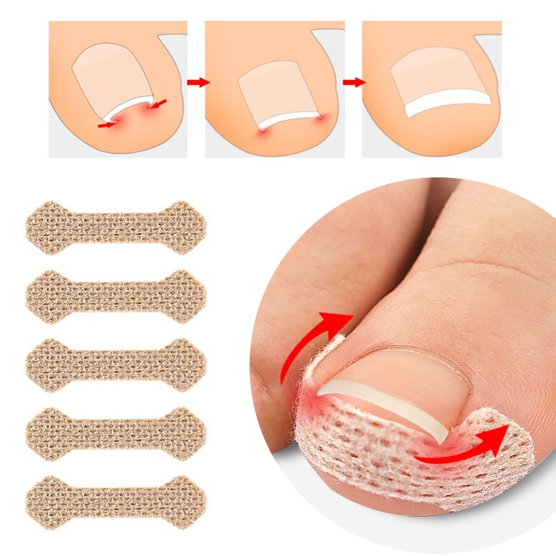指甲矯正貼紙內生腳趾甲矯正器貼片治療恢復矯正器修腳護理工具