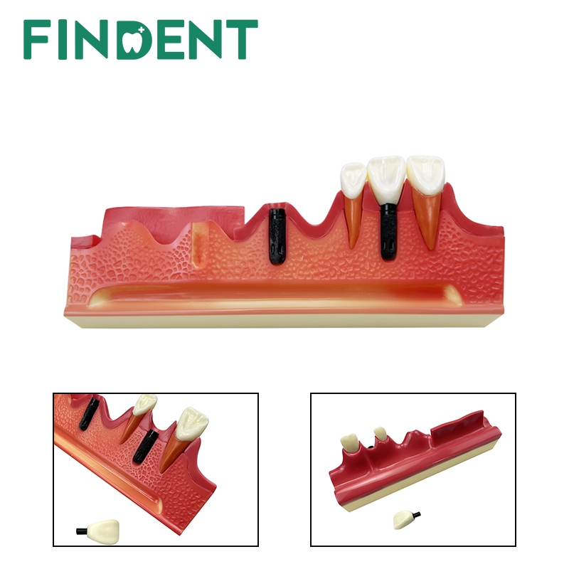 牙科typodont種植牙模型假牙種植步進工藝適用於牙醫演示教學培訓