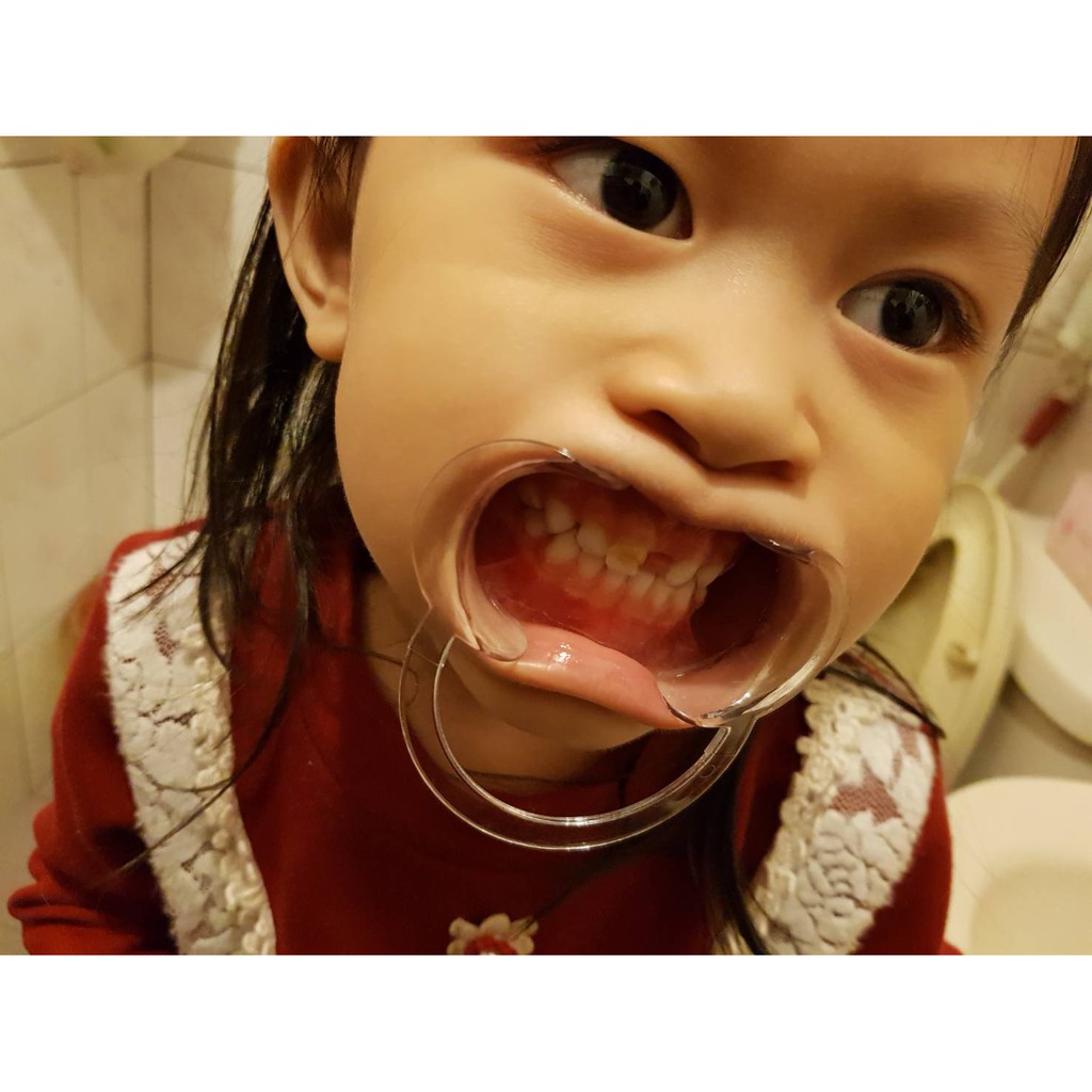 現貨 10個100 刷牙神器 兒童刷牙神器 擴嘴器 開口器 闊嘴器 張口器