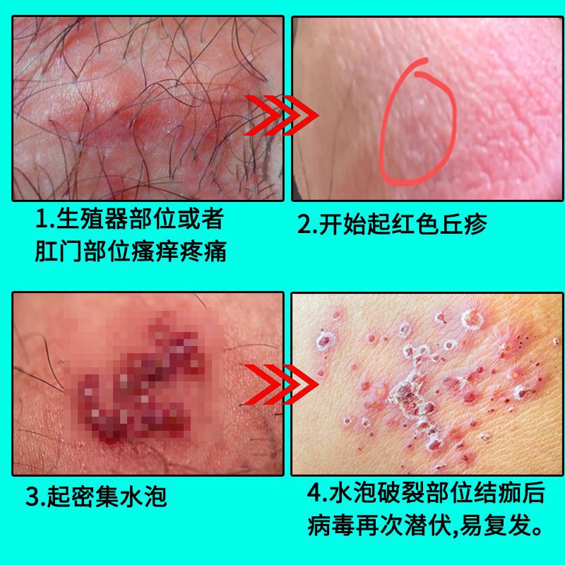 生殖器皰疹帶狀皰疹病毒感染鬼頭炎包皮炎紅點濕癢潰瘍糜爛止癢噴 蝦皮購物