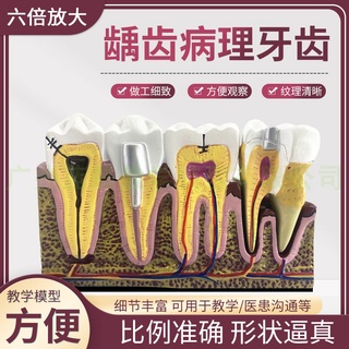 繁星優選牙科口腔6倍綜合病理模型 齲齒解剖根管及牙神經展示教學模型