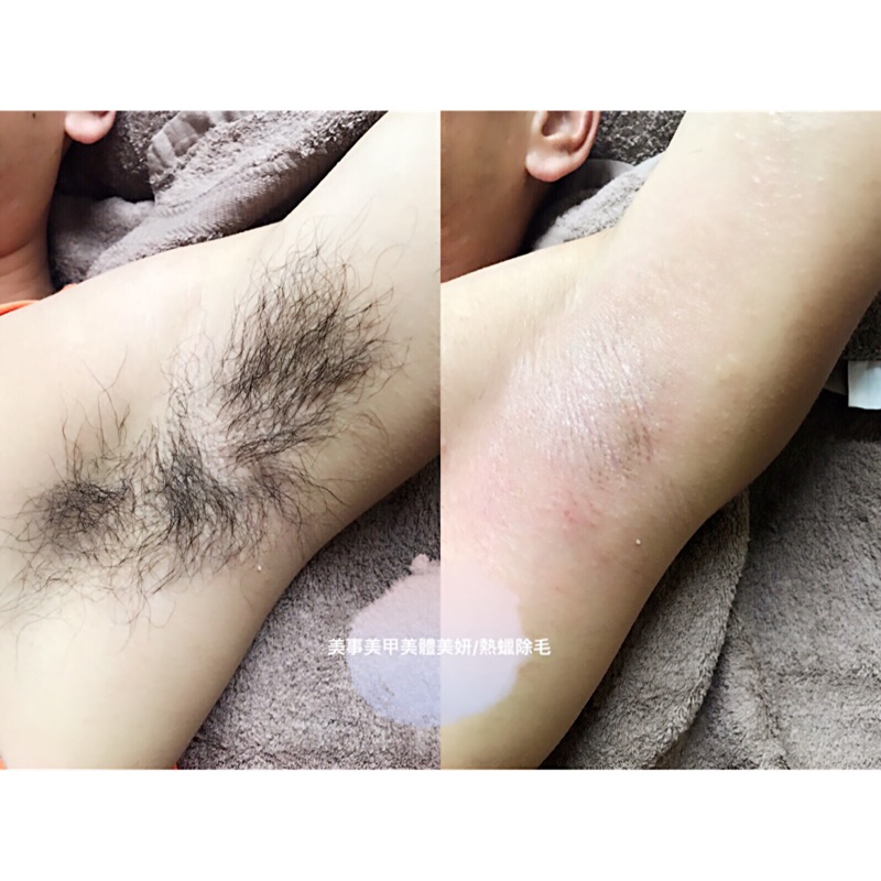 高雄茄萣白砂崙熱蠟除毛 腋下除毛 私密處除毛 美體all除毛 蝦皮購物