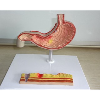 可開發票 胃潰瘍胃病理胃穿孔模型 人體消化系統模型 腸胃科 胃病 病變 教學教具模型ARGG客滿來