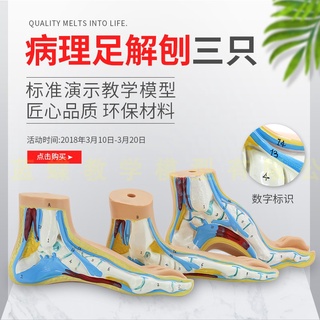 ♥❤正常足 扁平足 弓型足 模型 足部病理模型人體足部肌肉解剖模型