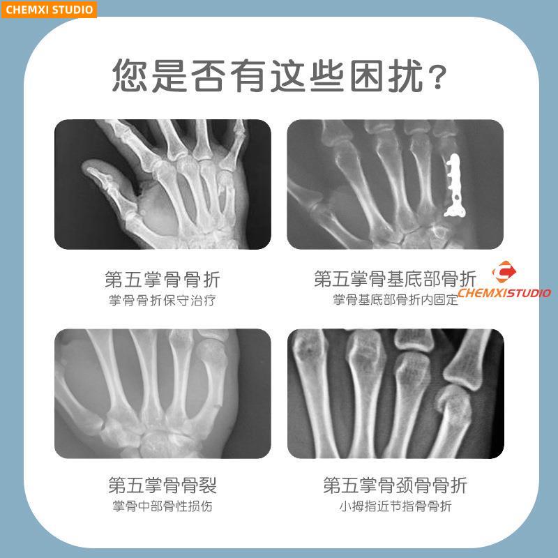 熱賣第五掌骨骨折手指指套 手掌小拇指支具固定器 手腕夾板固定護具220