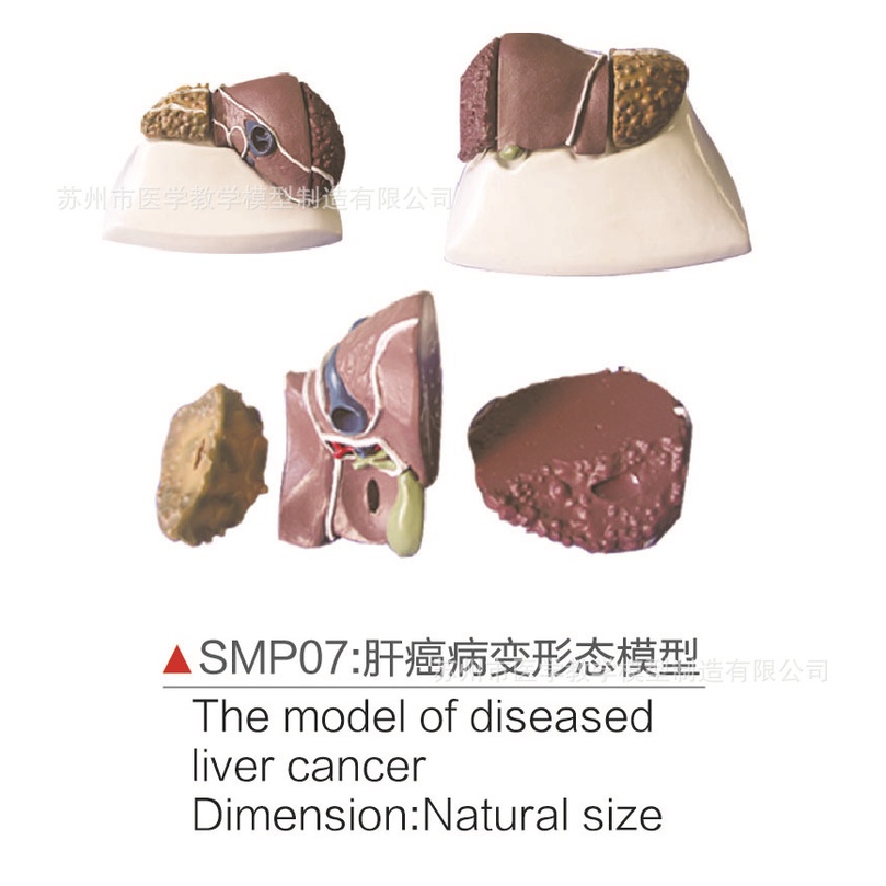 SMP07gan ai病變形態模型