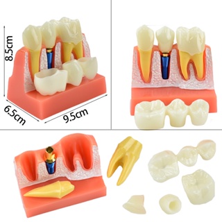 教學種植體分析牙冠橋可拆卸模型演示牙齒模型