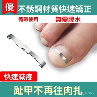 甲溝嵌甲矯正器🔥正甲扣 腳趾甲長肉裡糾正捲 指甲神器 嵌甲矯器 指甲矯正器 凍甲 甲溝炎 正甲扣 貼片腳趾甲長裡拉拉