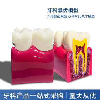 牙科教學器材6倍齲齒對比模型口腔模型教學模型牙齒模型#YT0609#