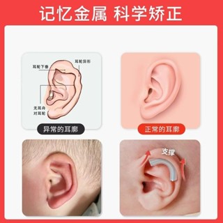 潮款！速發！耳朵矯正器嬰兒新生兒的矯形器招風耳寶寶定型神器糾正垂耳貼耳廓Ear orthotics for infant
