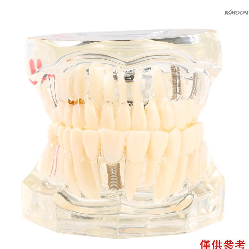 (mihappyfly)透明種植牙疾病牙齒模型教學牙齒工具牙科成人Typodont可拆卸牙齒模型