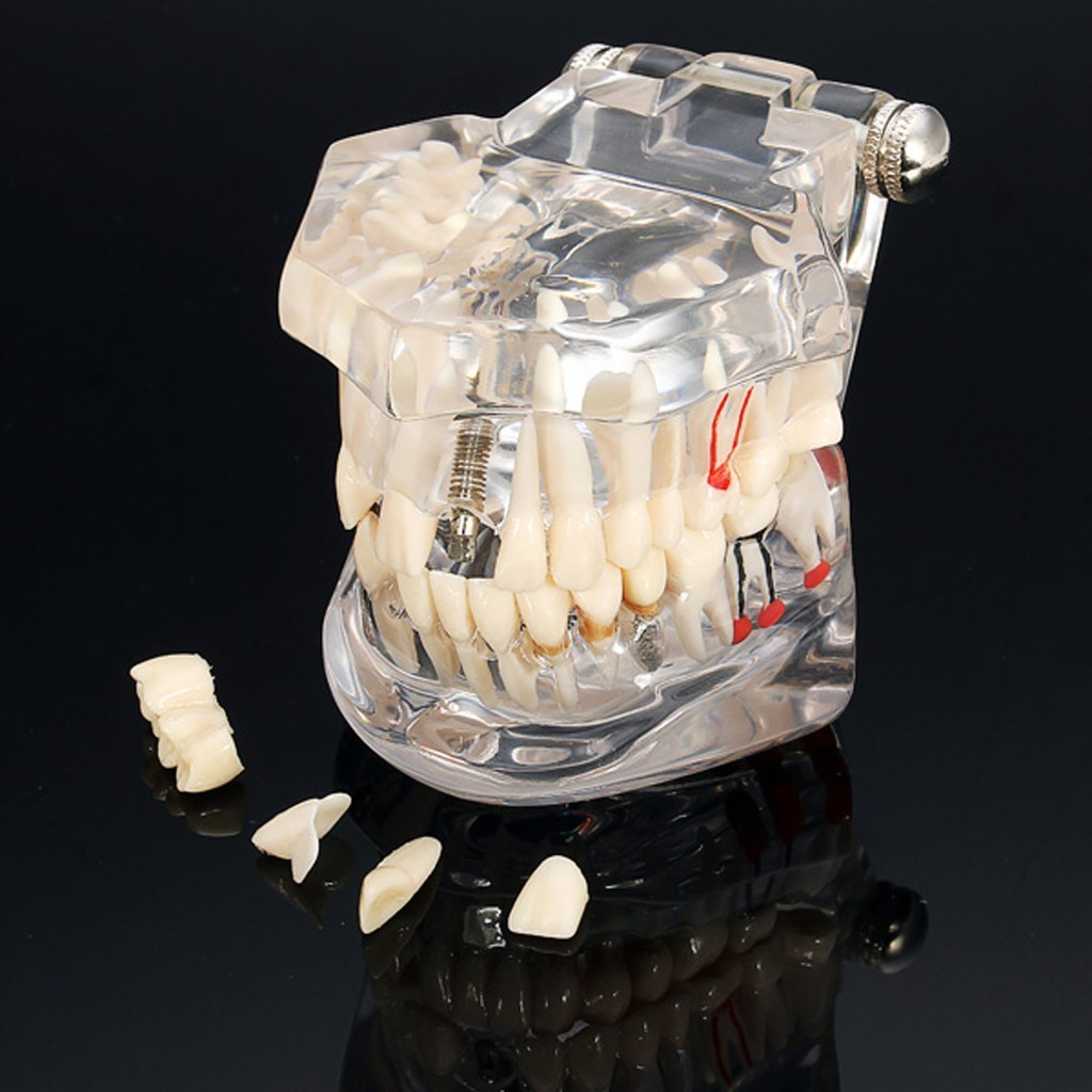 牙齒修復橋牙模型種植牙模型學生教學研究牙齒模型
