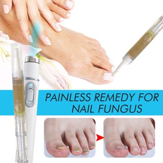 家用腳趾甲治療筆套裝抗真菌甲真菌病甲溝炎修復