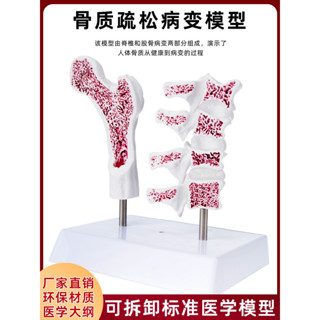 高品質模擬人體骨質疏鬆骨骼股骨頭脊椎雙凹塌陷楔形病理變正常教學模型
