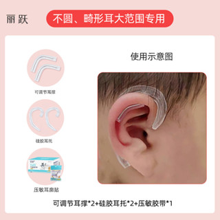 耳廓糾正3.19畸形新生兒耳朵矯形嬰兒垂耳耳型定型矯正器