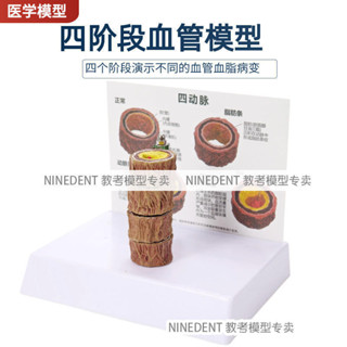 四階段病理血管人體支脈硬化粥樣心血管動脈模型硬化血脂形成模型