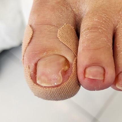 向內生長的指甲矯正套件向內生長的腳趾甲貼紙矯直治療恢復矯正器腳趾甲護理工具運動員足部運動學