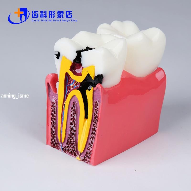 牙科 6倍齲齒對比模型 蛀牙演變過程 醫患教學溝通 牙齒模型 牙齒8116