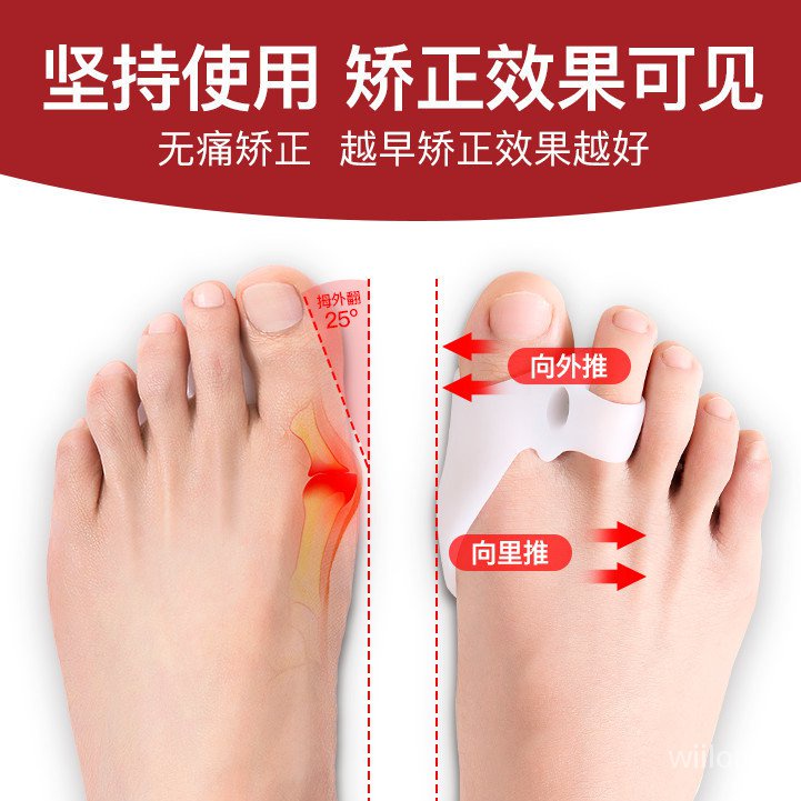 大腳骨拇指外翻硅膠矯正器分趾器防磨防痛【穿在鞋裏 效果更好】 DV3P
