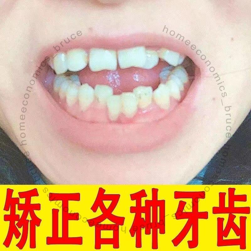 補牙神器牙齒矯正器9D透明隱形牙套成人齙牙地包天凸牙兒童夜間防磨糾正器6231