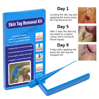 Blue Set Skin Tag Removal Kit Home Use Mole Wart Remover Equ